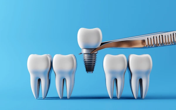 dental implants in south edmonton
