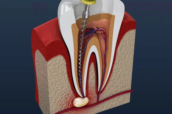 root canal therapy in south edmonton