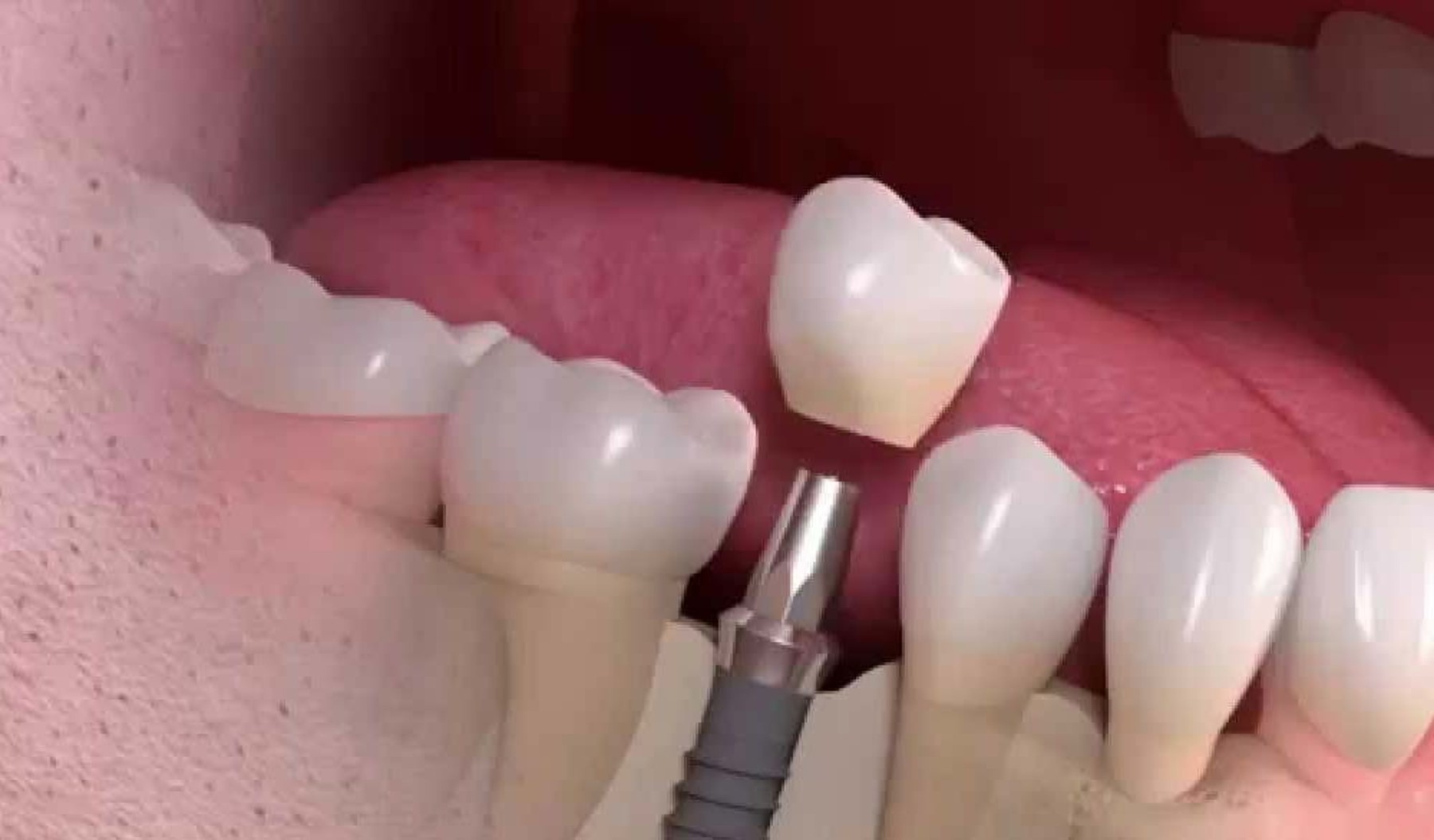 Can You Get a Temporary Tooth During the Dental Implant Process