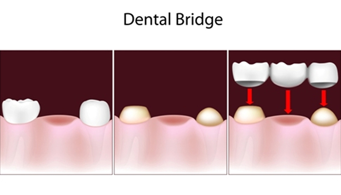 dental bridges in South Edmonton