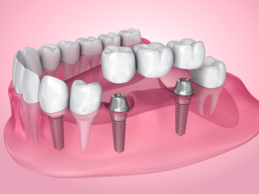 dental implants near you