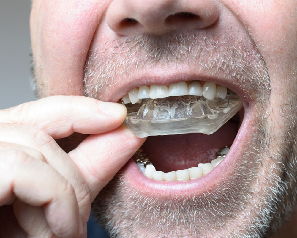 mouth guards in South Edmonton