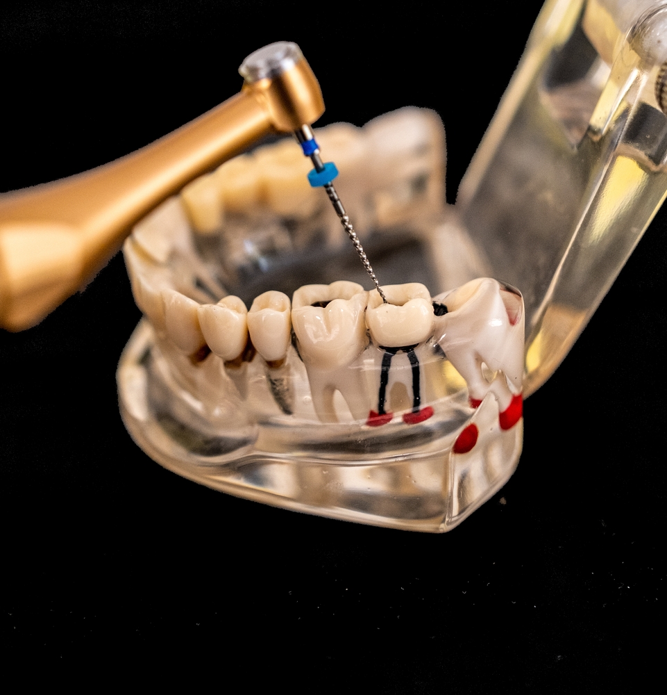 root canal infections symptoms causes treatment and prevention