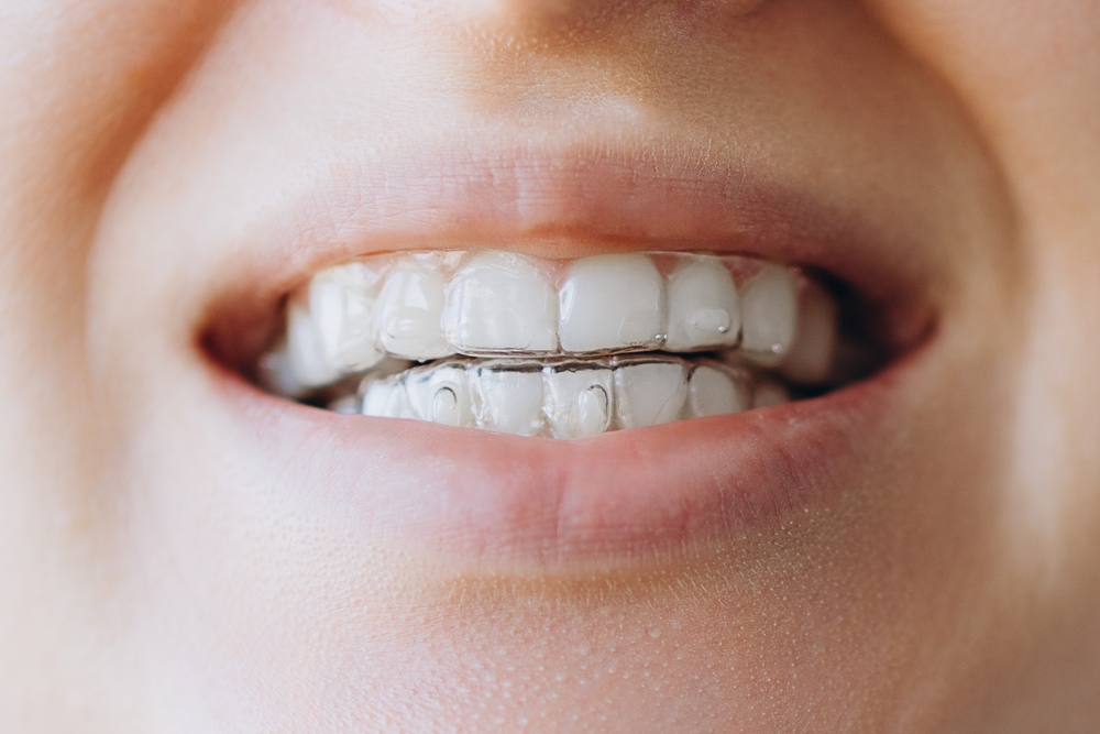 which teeth straightening option works faster than invisalign